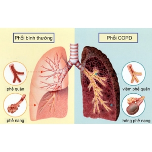 Cá thể hóa điều trị COPD