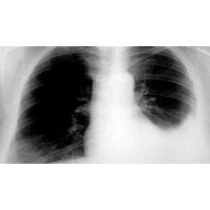 Tràn dịch màng phổi là gì?