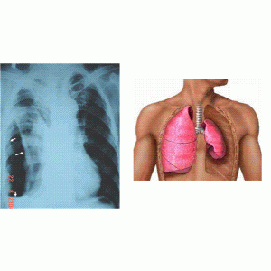 Di chứng lao phổi