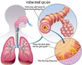 hình ảnh viêm phế quản