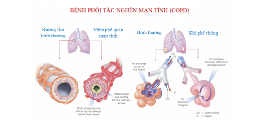Bệnh phổi tắc nghẽn mạn tính