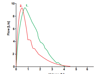 bieu-do-ho-hap-ky Hai biểu đồ đo hô hấp ký tiêu biểu