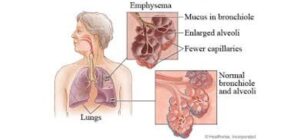 Các bệnh đồng mắc COPD