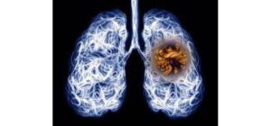 Điều trị COPD kèm di chứng do lao