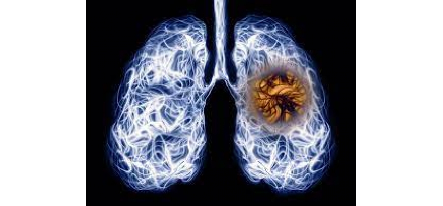 Điều trị COPD kèm di chứng do lao