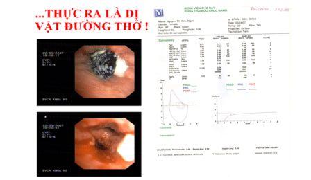 di_vat_duong_tho Dị vật đường thở chứ không phải hen