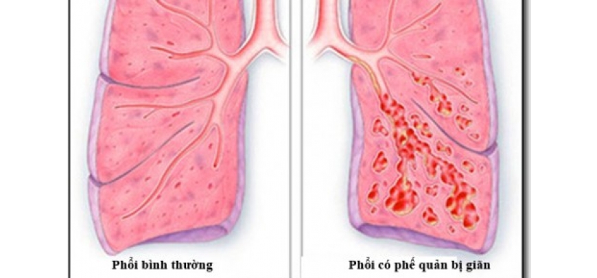 Giãn phế quản