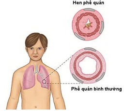 hen-phe-quan Hen phế quản