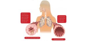 Bệnh nhân hen suyễn và các câu hỏi thường gặp
