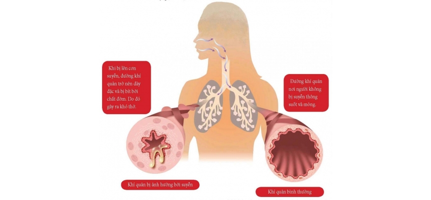 Bệnh nhân hen suyễn và các câu hỏi thường gặp