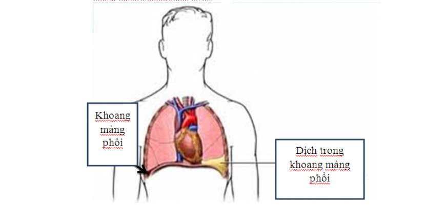 Nguyên nhân thường gặp của tràn dịch màng phổi