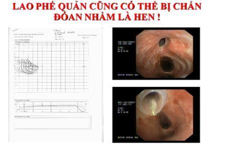 lao_phe_quan Lao phế qiarn bị chẩn đoán nhầm là hen