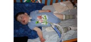 Ngưng thở khi ngủ ở trẻ em