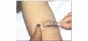 Phản ứng lao tố TST