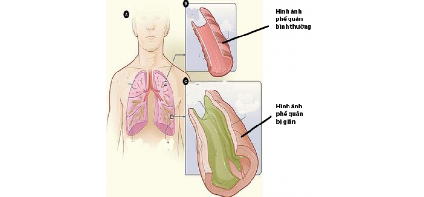 Ho có đờm kéo dài có thể là dãn phế quản