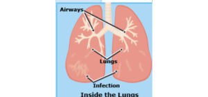 Viêm phổi ở trẻ em