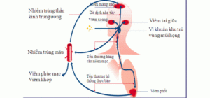 Tiêm ngừa phế cầu