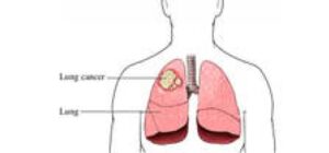 Tổng quan về ung thư phế quản