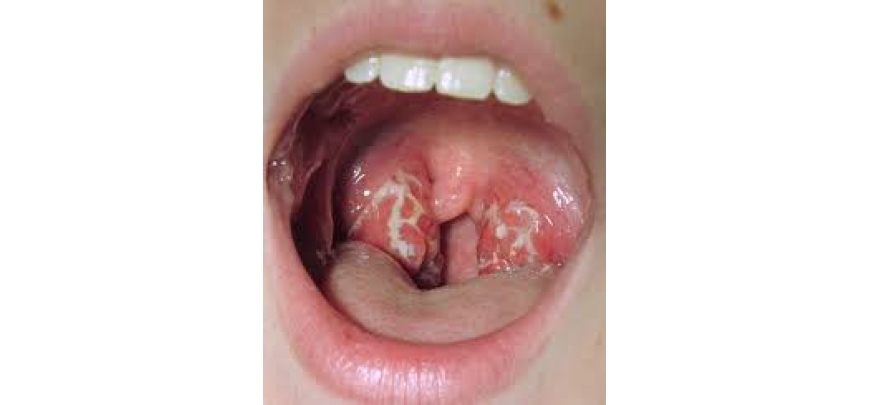 Viêm họng do liên cầu khuẩn (Streptoccocus)