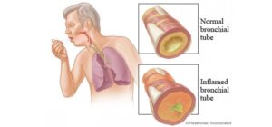 Viêm phế quản cấp