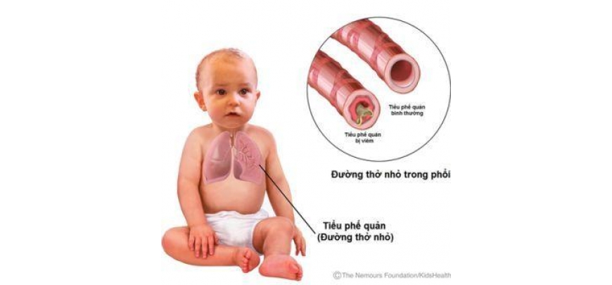 Viêm tiểu phế quản