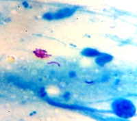 Hình ảnh vi khuẩn lao khi soi đờm trực tiếp