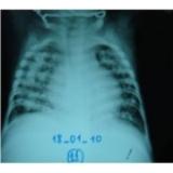 X-Quang Phổi của lao sơ nhiễm