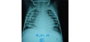 Lao sơ nhiễm ở trẻ em có thể bị chẩn đoán nhầm là hen