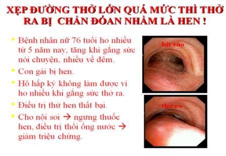 xep_duong_tho_lon Xẹp đường thở lớn bị chẩn đoán nhầm là hen